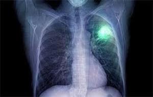 Recreació d'un tumor al pulmó. EIX