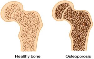 Osteoporosi . EIX
