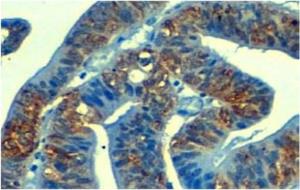 Pla detall de secció d'un càncer d'estómac vista al microscopi mostrant expressió aberrant de la proteïna YBX1 (tenyida de color marró) . IDIBELL