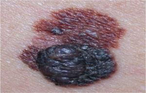 Melanoma maligne desenvolupant-se sobre un nevus previ. ACN