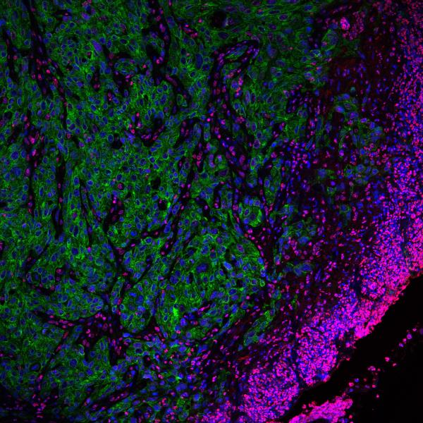 Front de cèl·lules tumorals invasives (en verd). Imatge de microscopia confocal difosa el 20 de novembre del 2018. IRB Barcelona