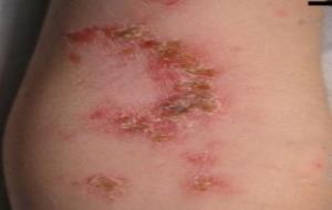 Impetigen. Dexeus