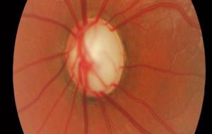 Creen un mapa que permet comprovar el grau de gravetat del glaucoma. IMO