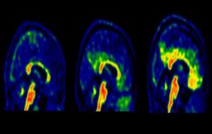 Diferents estadis de la patologia amiloide en un PET cerebral. BBRC