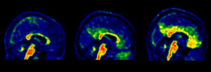 Diferents estadis de la patologia amiloide en un PET cerebral. BBRC