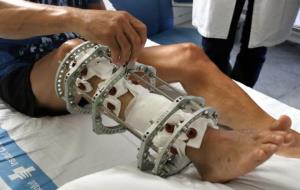 Pla detall de l'aparell que porta un pacient de Vall d'Hebron a qui li han fet osteogènesi a distracció. ACN