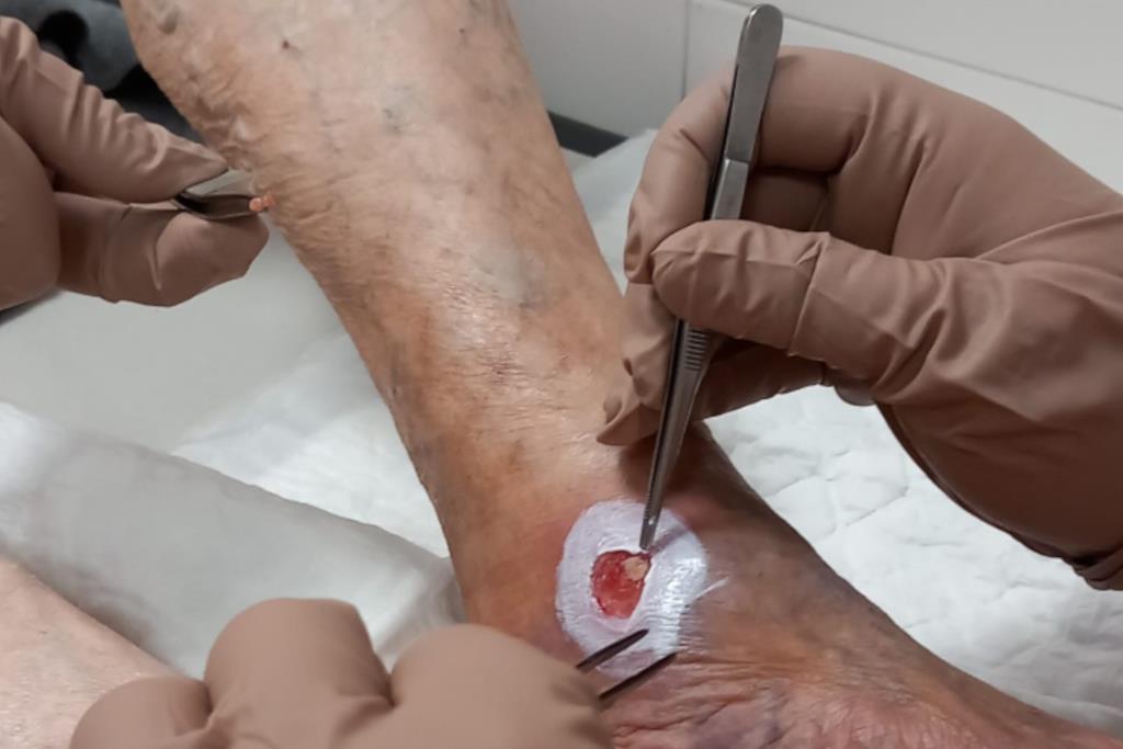 Un CAP de Martotell tracta amb èxit les ferides cròniques a través de microempelts de pell. ACN