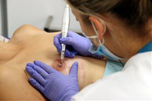 Micropigmentació, l'últim pas de la reconstrucció mamària. ACN