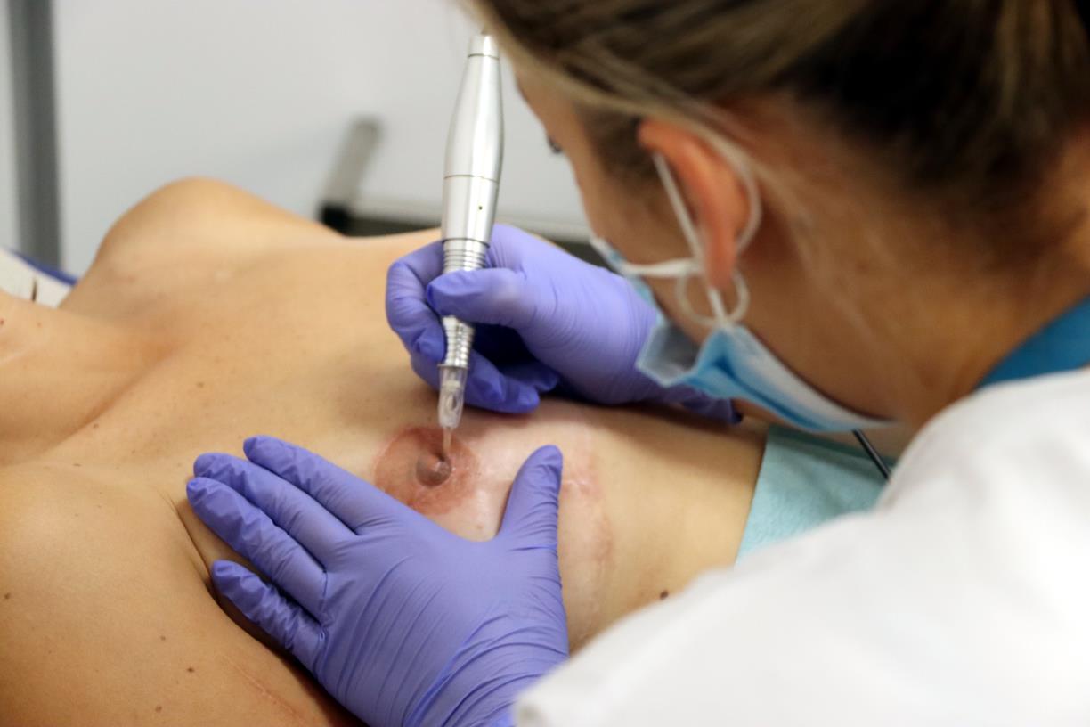 Micropigmentació, l'últim pas de la reconstrucció mamària. ACN